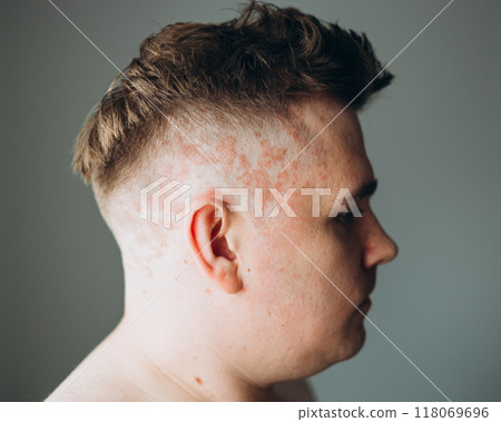 Psoriasis on the skin close-up, scalp, photos of dermatitis and eczema, skin problems concept, dermatology banner Psoriasis on the skin close-up, scalp, photos of dermatitis and eczema, skin problems concept, dermatology banner 118069696