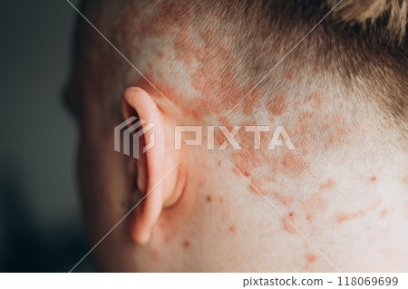 Psoriasis on the skin close-up, scalp, photos of dermatitis and eczema, skin problems concept, dermatology banner Psoriasis on the skin close-up, scalp, photos of dermatitis and eczema, skin problems concept, dermatology banner 118069699