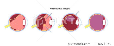 Vitreoretinal surgery poster Vitreoretinal surgery poster 118071039