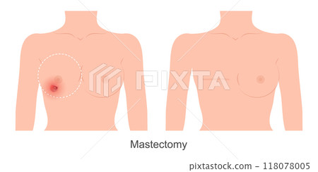 Mastectomy is a way of treating breast cancer. 118078005