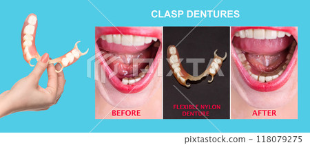 flexible nylon denture on female hand. Removable dentures flexible, devoid of nylon, hypoallergenic exempt from monomer 118079275