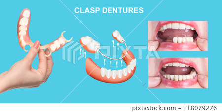 flexible nylon denture on female hand. Removable dentures flexible, devoid of nylon, hypoallergenic exempt from monomer 118079276