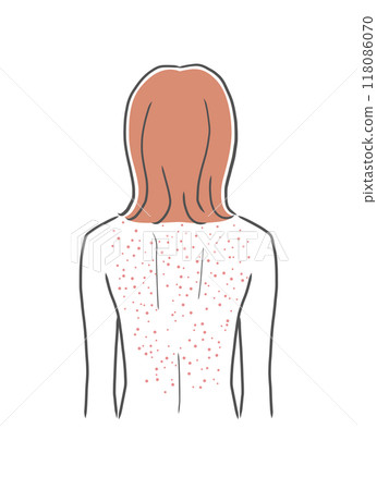 背上皮膚粗糙的女人插畫素材 118086070