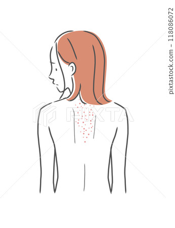背上皮膚粗糙的女人插畫素材 118086072