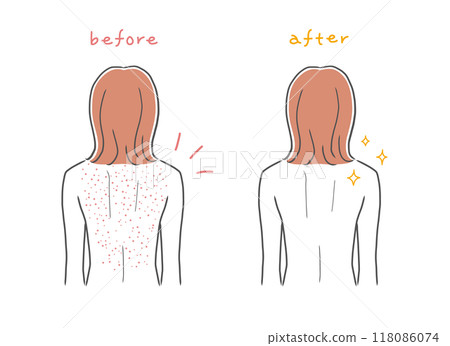 背部皮膚粗糙的女人和背部美麗的女人插畫素材 118086074