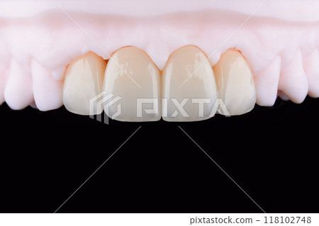High-quality naturally dental single crowns made of zirconia and stained like old man teeth. 118102748