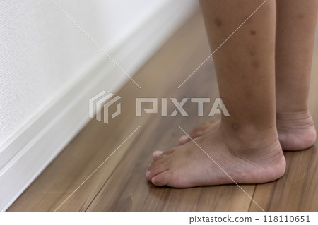 A child's feet with many scars from scratches (girl, Japanese, 4 years old) A child's feet with many scars from scratches (girl, Japanese, 4 years old) 118110651