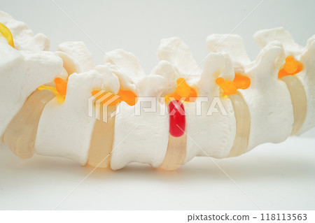 Spinal nerve and bone, Lumbar spine displaced herniated disc fragment, Model for treatment medical in the orthopedic department. 118113563