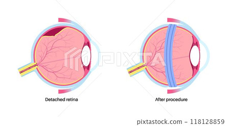 Scleral buckle procedure Scleral buckle procedure 118128859