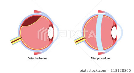 Scleral buckle procedure Scleral buckle procedure 118128860