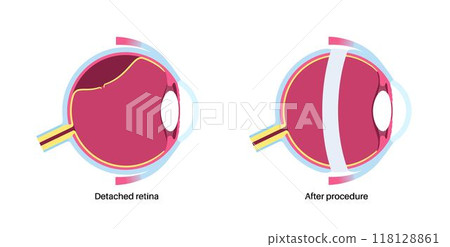 Scleral buckle procedure 118128861