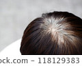 Back view of young people premature gray hair, showing black hoary hair roots on head change to senior old man outdoor. 118129383