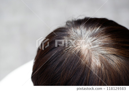 Back view of young people premature gray hair, showing black hoary hair roots on head change to senior old man outdoor. 118129383