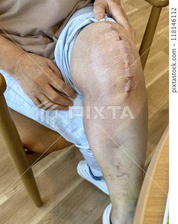 Scar from knee replacement surgery on a senior woman's leg two weeks after surgery 118146112