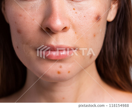 Closeup of Woman Face with Actinic Keratosis, Freckles, Age Spots, Wrinkles, and Sun Damage 118154988
