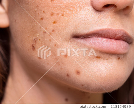 Closeup of Woman Face with Actinic Keratosis, Freckles, Age Spots, Wrinkles, and Sun Damage 118154989