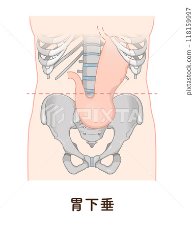 Gastroptosis, stomach, gastric atony, STAGE OF GASTROPTOSIS Gastroptosis, stomach, gastric atony, STAGE OF GASTROPTOSIS 118159997