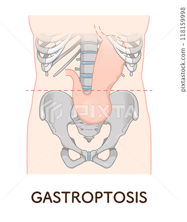 Gastroptosis, stomach, gastric atony, STAGE OF GASTROPTOSIS Gastroptosis, stomach, gastric atony, STAGE OF GASTROPTOSIS 118159998