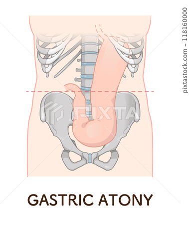 Gastroptosis, stomach, gastric atony, STAGE OF GASTROPTOSIS Gastroptosis, stomach, gastric atony, STAGE OF GASTROPTOSIS 118160000