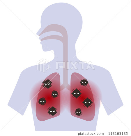 Lung infection 118165185