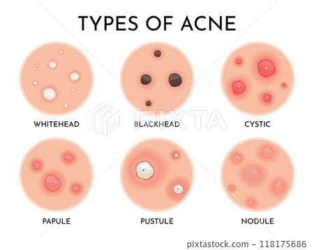 Understanding the Various Types of Acne A Comprehensive Visual Guide for Everyone Understanding the Various Types of Acne A Comprehensive Visual Guide for Everyone 118175686