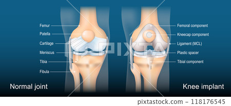 Total knee arthroplasty. Knee joint replacement 118176545