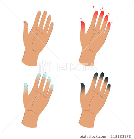 Frostbite stages infographic vector isolated 118183178