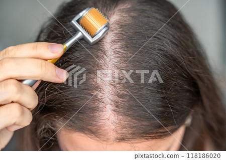 Close up view of young woman using microneedle derma roller on head for stimulating new hair growth in home. Treatment for the healthy scalp. Close up view of young woman using microneedle derma roller on head for stimulating new hair growth in home. Treatment for the healthy scalp. 118186020