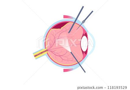 Vitrectomy surgical poster 118193529