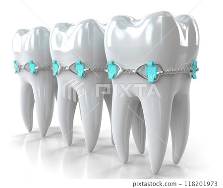Straightening journey: orthodontic bracket or brace, focusing on dental treatment concept designed to correct misaligned teeth, enhance oral function, boost confidence with beautifully aligned smile. 118201973