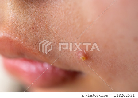 青春痘 痘痘 嘴 118202531