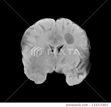 Coronal View of Human Brain with Ischemic Stroke for Medical and Educational Use 118215801
