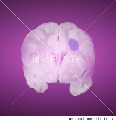 Coronal View of Human Brain with Ischemic Stroke Highlighted in Purple on Purple Background 118215803