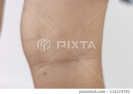 Legs of a girl with hand, foot and mouth disease (4 years old, Japanese) Legs of a girl with hand, foot and mouth disease (4 years old, Japanese) 118224702