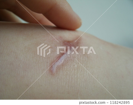 即使膝蓋傷口癒合後仍殘留的疤痕 118242895