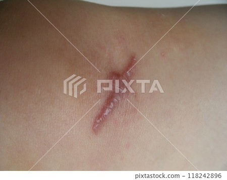 Knee wound condition 3 months after injury and suture treatment 118242896