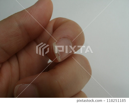 Split nail on index finger (onychoschizoschisis) 118251185