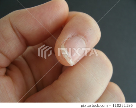 雙指甲的症狀，即指甲表面薄薄剝落。 118251186