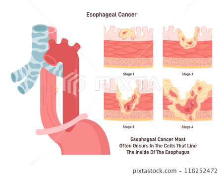 Esophageal cancer. Malignant inflammation of esophagus wall cells. Tissues of the esophagus carcinoma. Dangerous effect of cigarette smoking. Flat vector illustration Esophageal cancer. Malignant inflammation of esophagus wall cells. Tissues of the esophagus carcinoma. Dangerous effect of cigarette smoking. Flat vector illustration 118252472