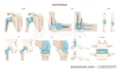 Joint implantation set. Injured or distracted human joint replaced with artificial prosthesis made of titanium. Osteoporosis and osteoarthritis treatment surgery. Flat vector illustration 118252547