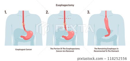 Esophagectomy. Partial excision of the esophagus. Surgical procedure of gullet recession or removement. Esophageal cancer treatment. Flat vector illustration 118252556