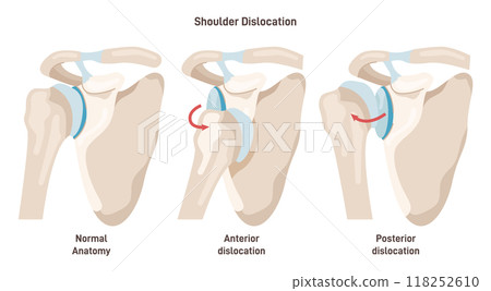 Shoulder dislocation types. Arm injury, upper arm bone pops out of the cup-shaped socket of shoulder blade. Glenohumeral joint dislocation. Flat vector illustration Shoulder dislocation types. Arm injury, upper arm bone pops out of the cup-shaped socket of shoulder blade. Glenohumeral joint dislocation. Flat vector illustration 118252610