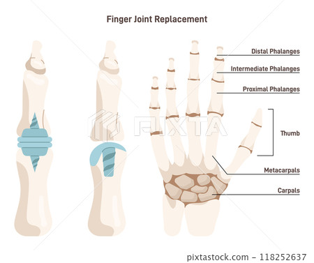 Joint implantation. Injured or distracted human joint replaced with artificial prosthesis made of titanium. Osteoporosis and osteoarthritis treatment surgery. Flat vector illustration 118252637