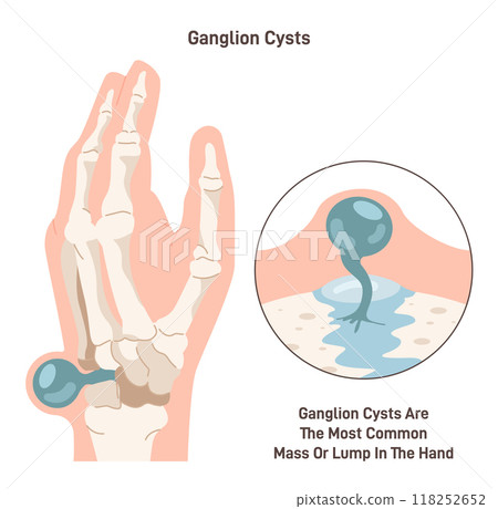 Ganglion cyst. Fluid-filled lump under the skin of a wrist or hand. Synovial cyst over a joint or in a tendon. Flat vector illustration 118252652