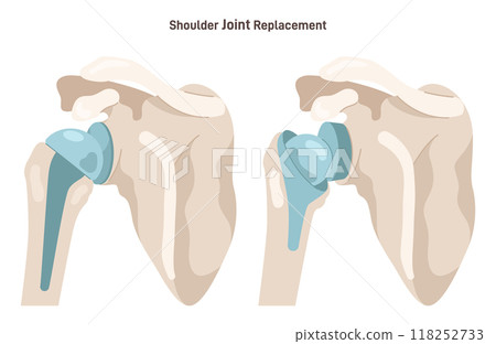 Joint implantation. Injured or distracted human joint replaced with artificial prosthesis made of titanium. Osteoporosis and osteoarthritis treatment surgery. Flat vector illustration 118252733