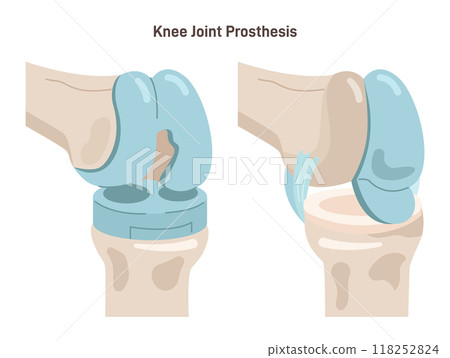 Joint implantation. Injured or distracted human joint replaced with artificial prosthesis made of titanium. Osteoporosis and osteoarthritis treatment surgery. Flat vector illustration 118252824