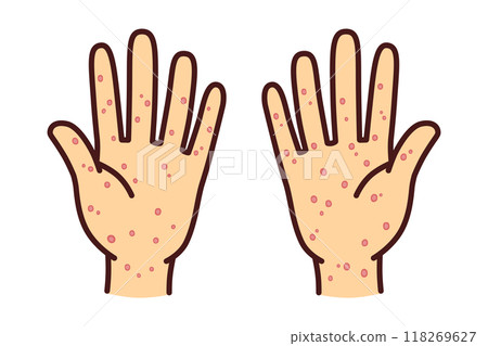 Syphilis skin disease hand illustration material 118269627