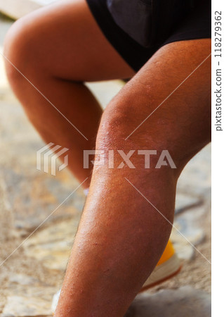 Detailed CloseUp Examination of a Skin Condition Present on an Individuals Arm Detailed CloseUp Examination of a Skin Condition Present on an Individuals Arm 118279362