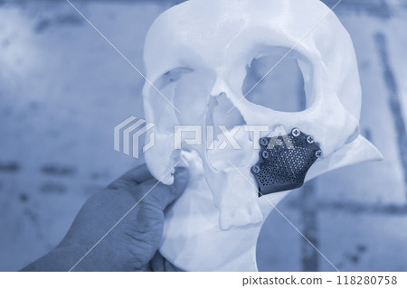 A person holding in hand a prototype of a human skull from white plastic with an implant from biocompatible titanium printed on a 3D printer. Bioengineering patient-specific slit-facial prosthesis. 118280758