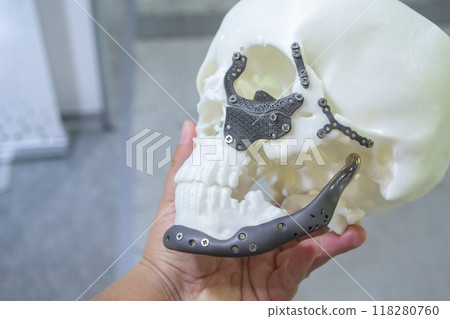 Man holding in hand proto-human skull from white plastic with titanium implants in form of plates and surgical templates printed on 3D printer. Biointegrated prosthesis Man holding in hand proto-human skull from white plastic with titanium implants in form of plates and surgical templates printed on 3D printer. Biointegrated prosthesis 118280760